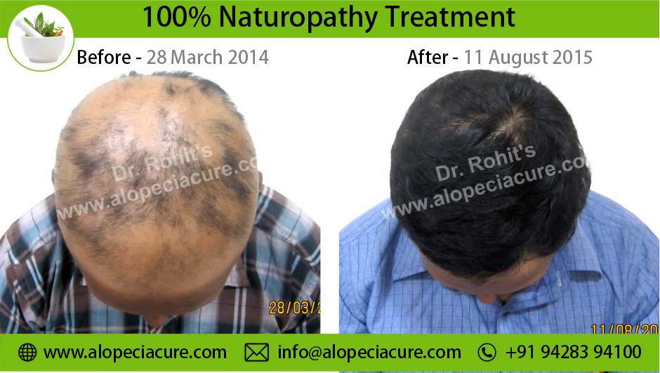 Alopecia Areata Result 6